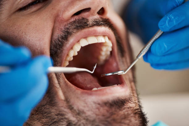 Best Chipped Tooth Repair Near Me  in Fort Knox, KY